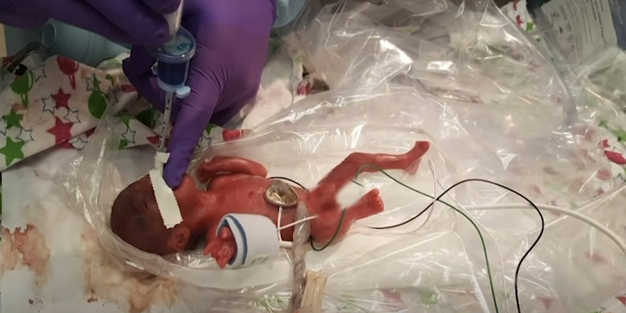 Γεννήθηκε το μικρότερο μωρό στον κόσμο με βάρος 245γρ- Τους είπαν ότι σε μια ώρα θα πεθάνει- VIDEO