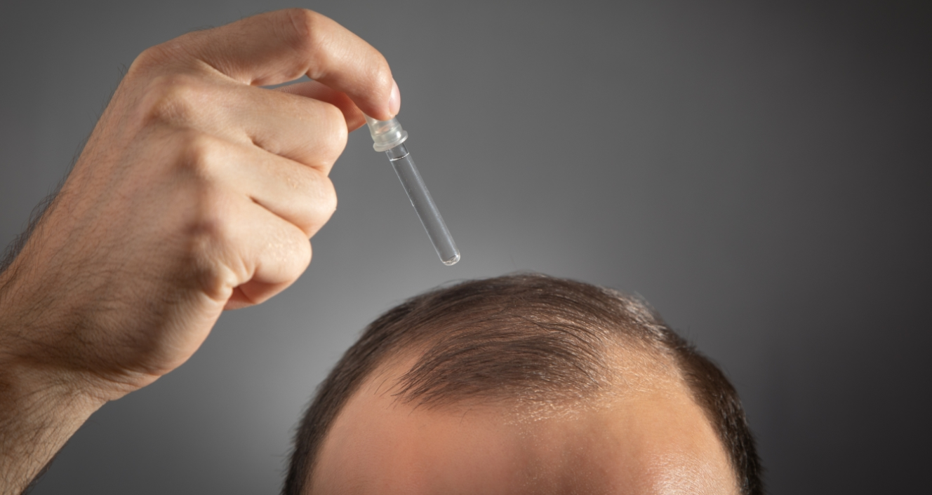 Τέλος η φαλάκρα; Νέος φυτικός ορός από την Κίνα συνδέεται με επανεμφάνιση μαλλιών μέσα σε λίγες εβδομάδες