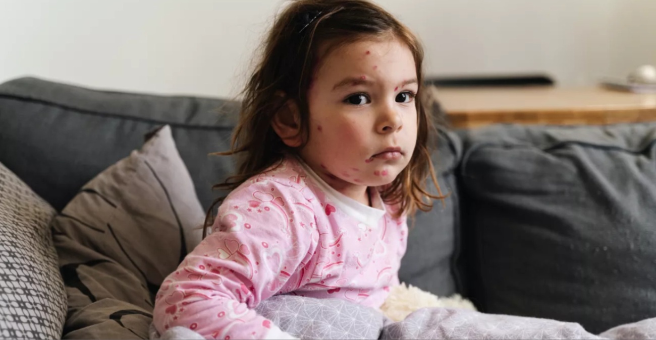 Ιλαρά: Λιγότερα κρούσματα στην Ευρώπη το 2025, αλλά διπλάσια σε σχέση με το 2023