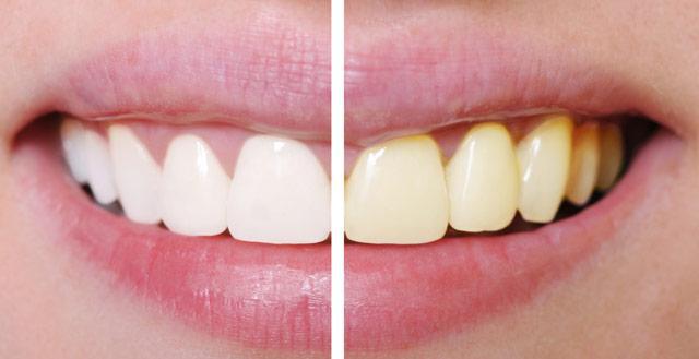 3 «αθώες» συνήθειες που κιτρινίζουν τα δόντια σου χωρίς να το καταλαβαίνεις