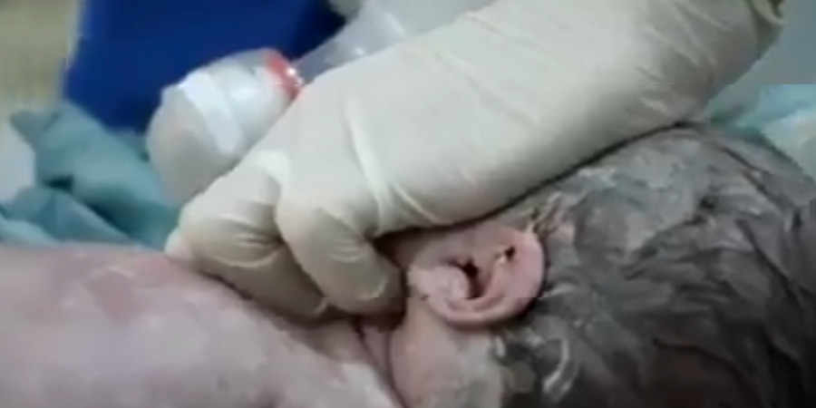 Βρέφος γεννιέται νεκρό- Δεν το έβαλαν κάτω οι γιατροί- VIDEO