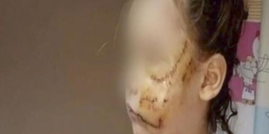 Αγρια επίθεση πιτ μπουλ στο Ιλιον: Δάγκωσε κοριτσάκι 3,5 ετών που έλεγε τα κάλαντα - VIDEO