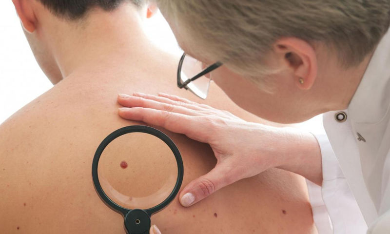 Καρκίνος του δέρματος: 7 σημάδια που δεν πρέπει να αγνοείτε