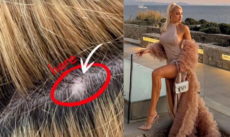 Τούνη: «Όταν στρεσάρομαι βγάζω τριχοφάγους, αλλά είναι καλύτερα από σοβαρότερα προβλήματα υγείας»