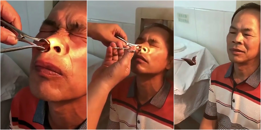 Βδέλλα ζούσε στη μύτη 51χρονου για δυο εβδομάδες – «Η νοσοκόμα σχεδόν λιποθύμησε» - VIDEO