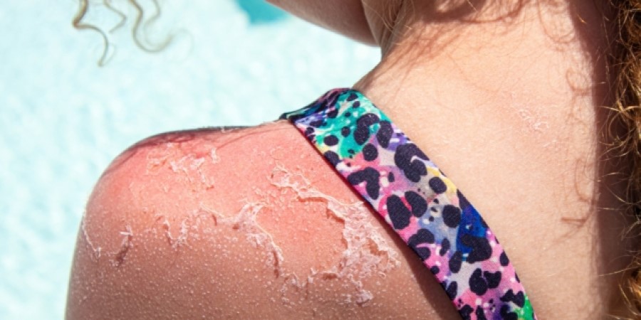 Πώς να προστατέψετε το δέρμα από ρυτίδες και άλλες βλάβες που προκαλεί ο ήλιος