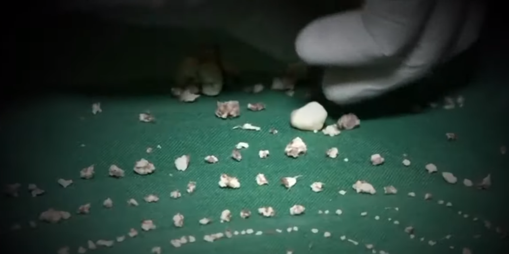 Γιατροί έβγαλαν 526 δόντια από το στόμα ενός 7χρονου στην Ινδία - VIDEO