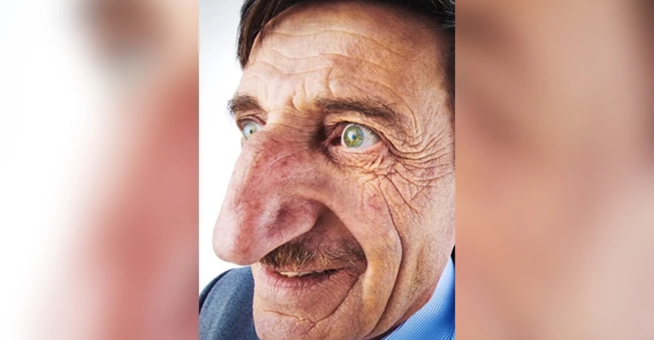 Πέθανε ο κάτοχος της μακρύτερης μύτης στον κόσμο – Του απονεμήθηκε ο τίτλος τρεις φορές