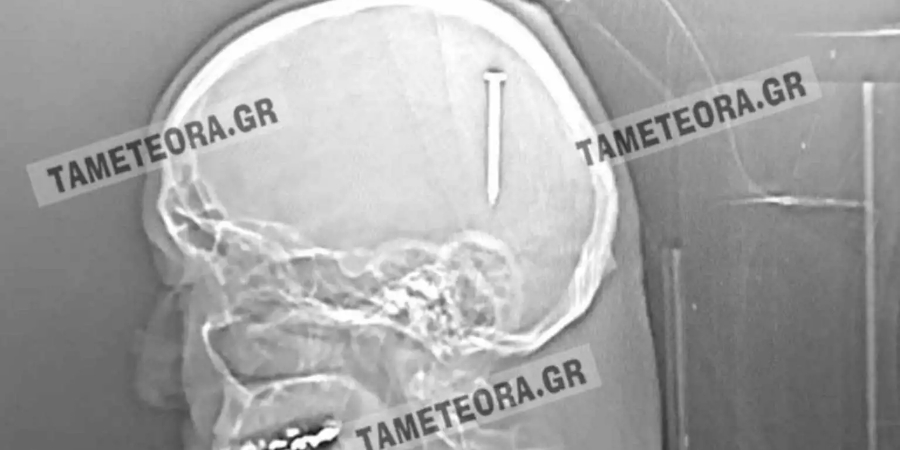 Καλαμπάκα: Βρέθηκε με αυτό το καρφί μέσα στο κεφάλι του – Η ακτινογραφία και η μεγάλη μάχη με τον χρόνο