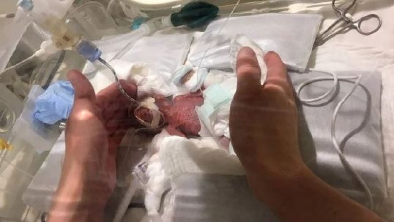 Ευχάριστα νέα - Το μικρότερο νεογέννητο αγοράκι του κόσμου επιτέλους πήγε σπίτι του - ΦΩΤΟΓΡΑΦΙΑ