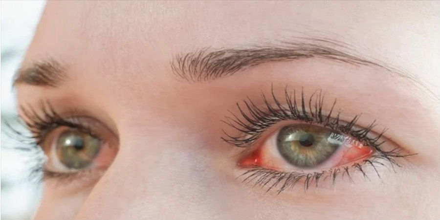 Πώς μπορεί η ευλογιά των πιθήκων να επηρεάσει τα μάτια και την όραση