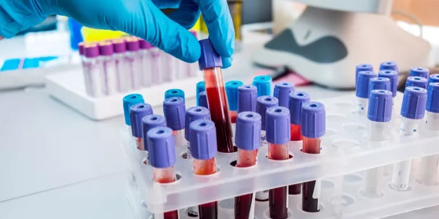 Ιατρική ανακάλυψη: Απλή εξέταση αίματος μπορεί να διαγνώσει τύπους καρκίνου του εγκεφάλου