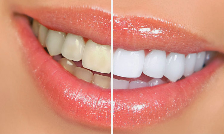 Δείτε τον πιο εύκολο και οικονομικό τρόπο για να λευκάνετε τα δόντια σας