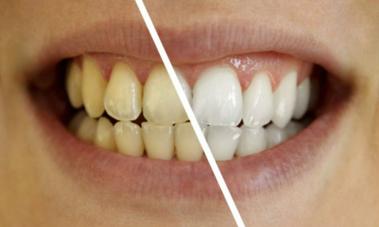 Το «μαγικό» διάλυμα για πιο αστραφτερά δόντια με το βούρτσισμα