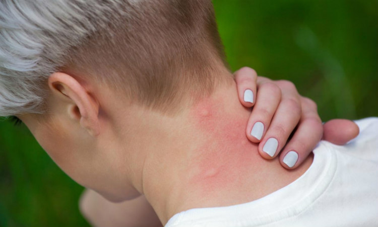 Γιατί τα κουνούπια σας τσιμπάνε περισσότερο από άλλους ανθρώπους