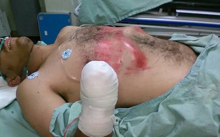Mεξικό: Πολίτες έπιασαν κλέφτη επ’ αυτοφώρω και του έκοψαν το χέρι