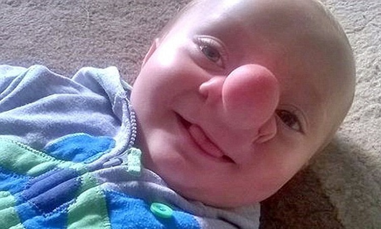 Το μωρό που μεγαλώνει με τον εγκέφαλο να αναπτύσσεται στη μύτη του