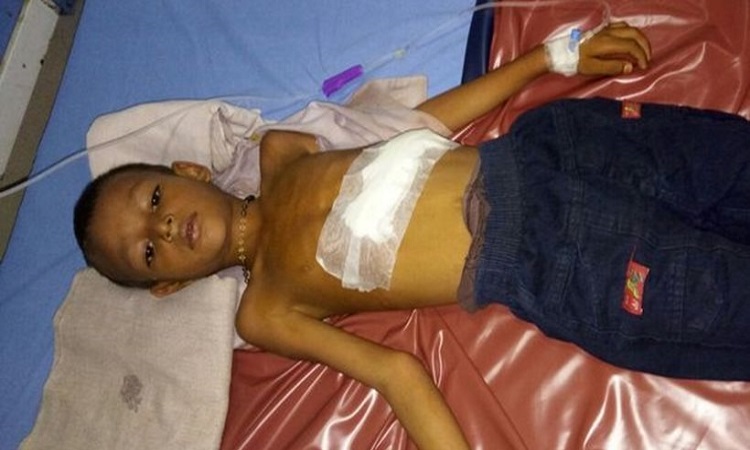 Σπάνια περίπτωση στην Ινδία - 6χρονος «κυοφορούσε» το δίδυμο αδερφό του