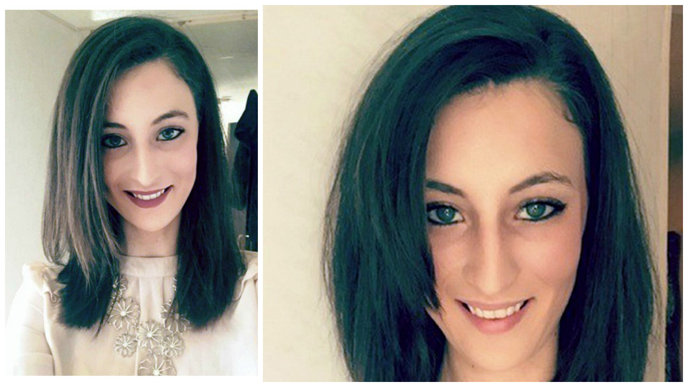 Σκληρές εικόνες:Πήγε για βαφή μαλλιών, έπαθε χημικά εγκαύματα και έχασε τα μαλλιά της
