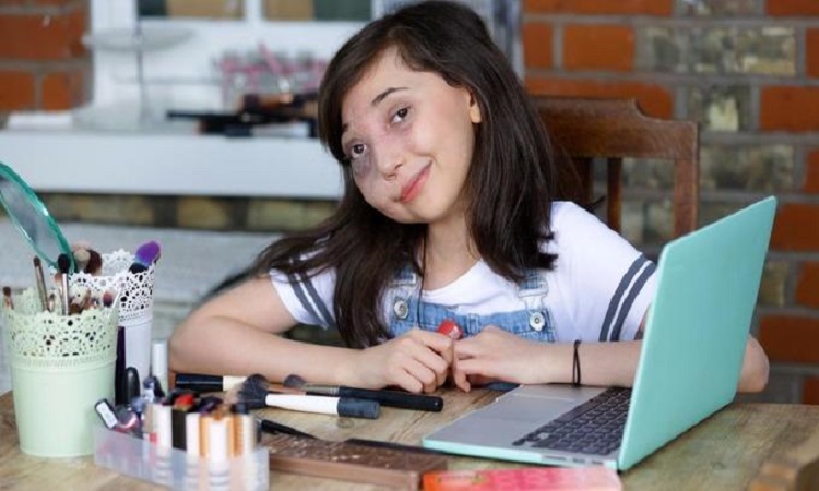 Η 12χρονη Κύπρια με την σπάνια πάθηση και τους 80.000 followers (VIDEO)