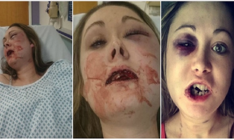 Εξοργιστικές εικόνες: Της έσπασε το σαγόνι και τρία δόντια επειδή δεν ήθελε να κάνουν σεξ