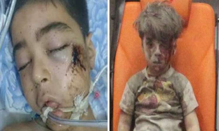 Πέθανε ο αδελφός του 5χρονου Ομράν που συγκλόνισε τον κόσμο