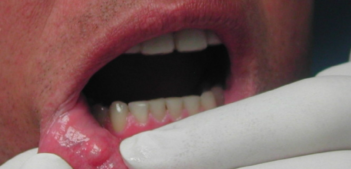 Καρκίνος του στόματος: Προσοχή στα «αθώα» συμπτώματα – Ποιοι είναι οι παράγοντες κινδύνου