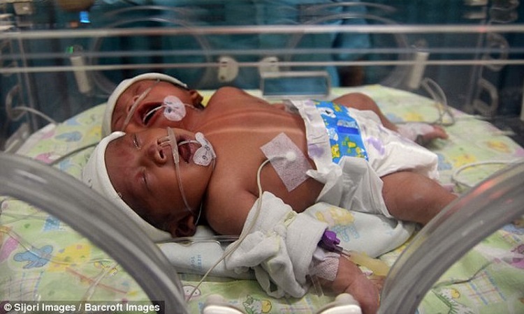 Μωρό με δύο κεφάλια γεννήθηκε στην Ινδονησία! - VIDEO - ΦΩΤΟ