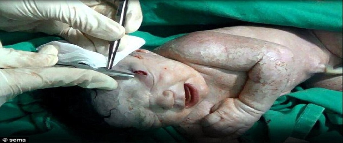 Απίστευτο! Βρέφος στη Συρία γεννήθηκε με θραύσμα οβίδας στο κεφάλι!  (Video)