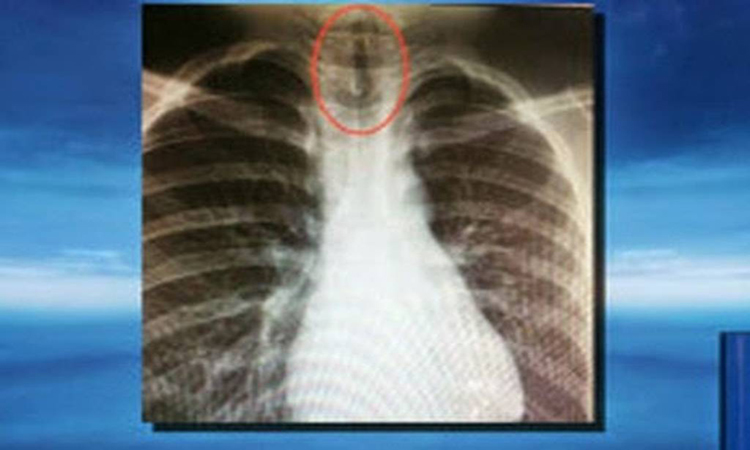Απίστευτο κι όμως αληθινό: Δείτε τι βρήκαν οι γιατροί στον πνεύμονα ενός 11χρονου αγοριού