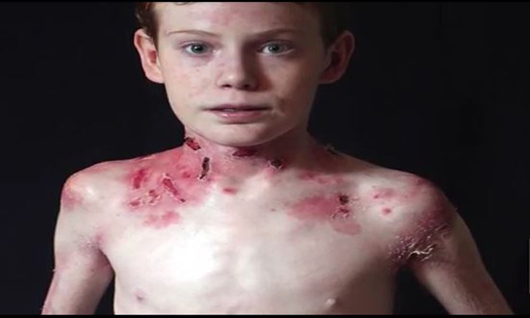 Ζωή μαρτύριο για 14χρονο: Τι είναι η ασθένεια που κάνει το δέρμα του σαν φτερά πεταλούδας