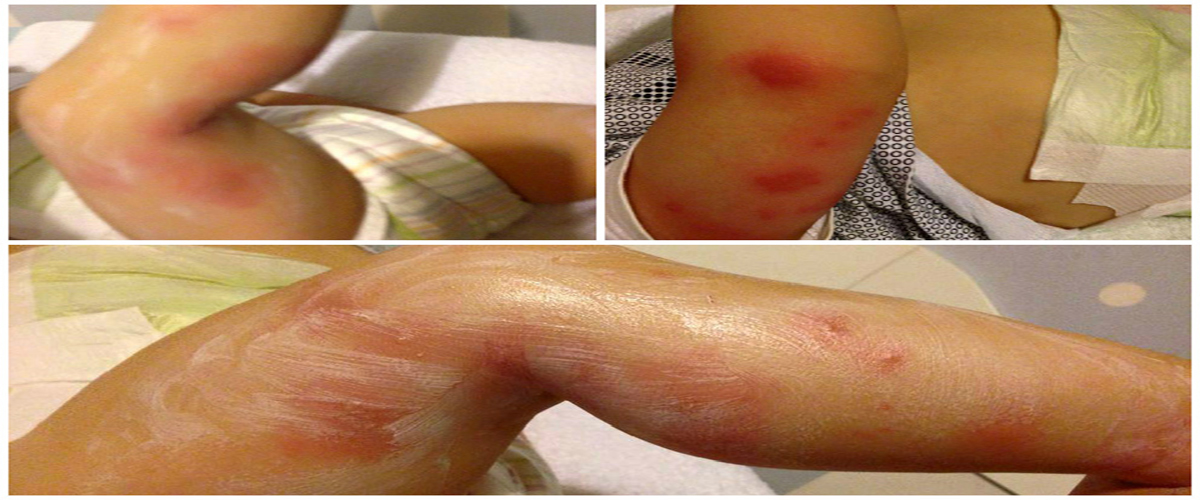 Λάρνακα: Φωτογραφίες σοκ -  Δείτε πως έγινε το σώμα μικρού παιδιού από τα τσιμπήματα κουνουπιών! Έξαλλοι οι γονείς του