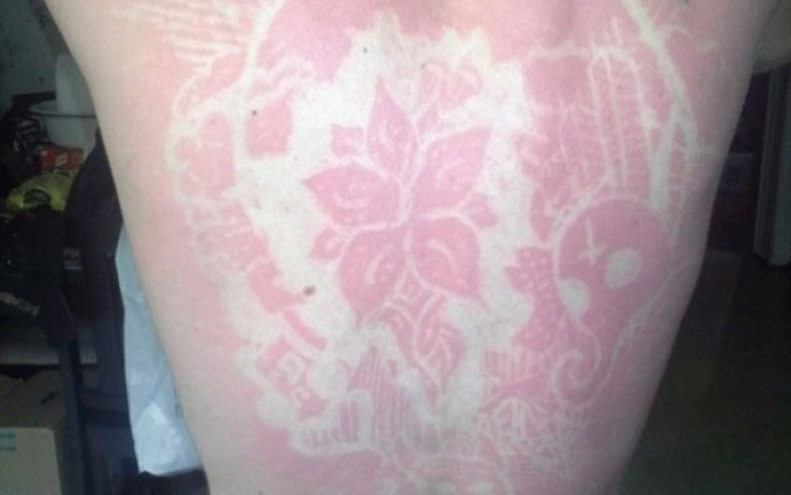Νέα επικίνδυνη μόδα για τατουάζ… από τον ήλιο (Φώτο-Βίντεο)