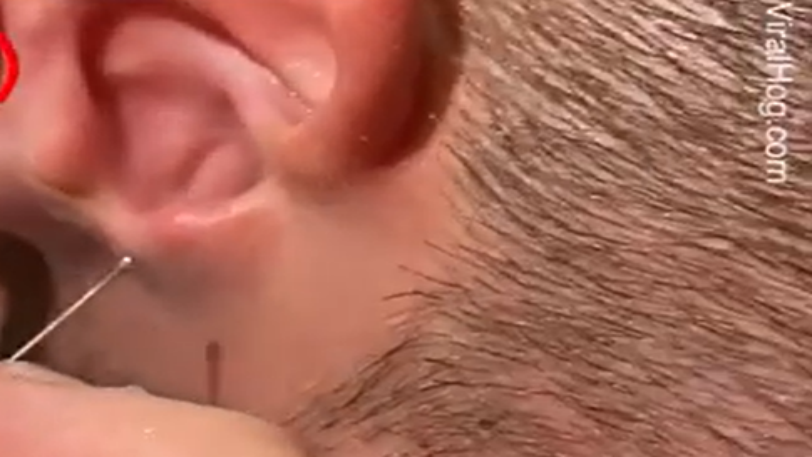 Νόμιζε πως κουφάθηκε αλλά τελικά είχε μπει ένα τεράστιο έντομο στο αυτί του - VIDEO
