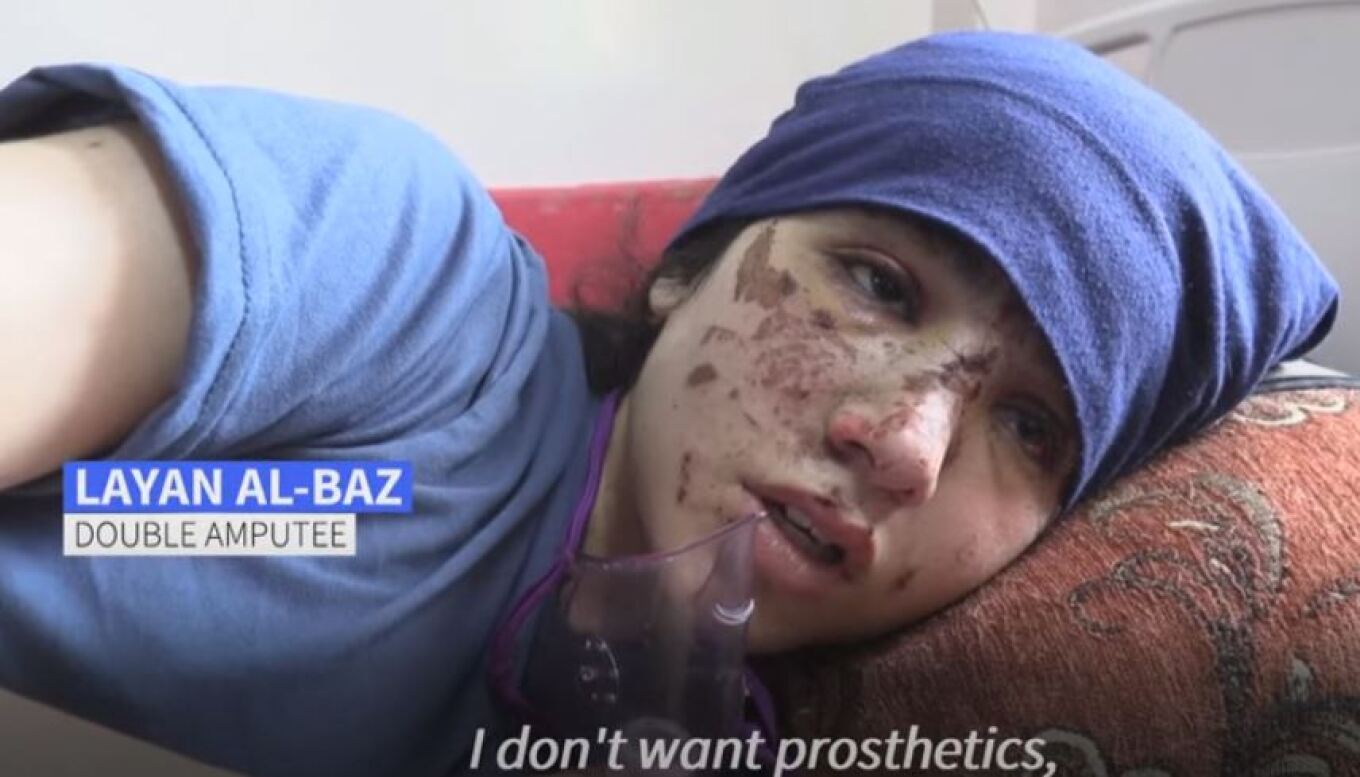 «Ξαναβάλτε μου τα πόδια μου» - Η φρικτή πραγματικότητα των παιδιών στη Γάζα που ακρωτηριάστηκαν