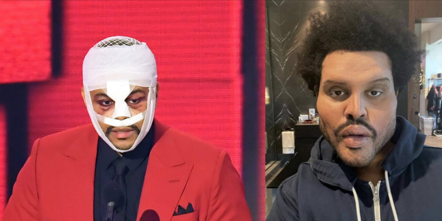 Ο Weeknd έβγαλε τους επιδέσμους! Σοκαριστική αλλαγή στο πρόσωπο του - ΒΙΝΤΕΟ