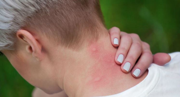 Γιατί τα κουνούπια σας τσιμπάνε περισσότερο από άλλους ανθρώπους