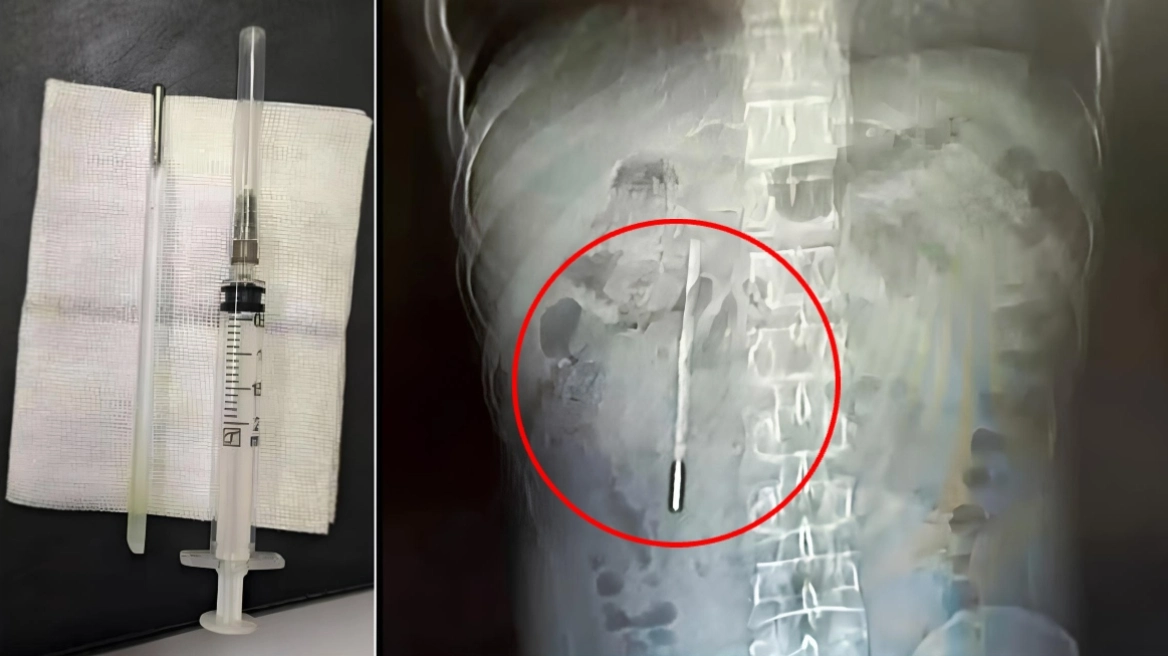 Δείτε εικόνα: Άνδρας ζούσε επί 20 χρόνια με ένα... θερμόμετρο στο σώμα του, το αφαίρεσε μετά από έντονους πόνους στο στομάχι