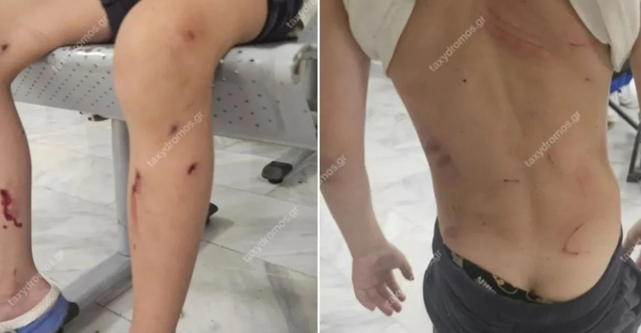 Βόλος: Από θαύμα γλίτωσε 7χρονος όταν του επιτέθηκαν αδέσποτα σκυλιά - Παραλίγο να το κατασπαράξουν, λέει η μητέρα του