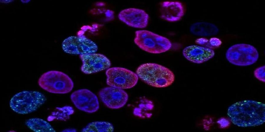 Καρκίνος του προστάτη: Σημαντική επιστημονική ανακάλυψη - Μεταλλάξεις σε 11 γονίδια εντόπισαν οι ερευνητές