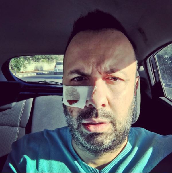 Ατύχημα για τον Τάσο Τρύφωνος - Η φωτογραφία που προκάλεσε πανικό στο instagram - ΦΩΤΟΓΡΑΦΙΑ